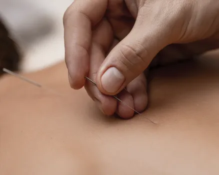 Acupuntura ayuda en la sanación de dolores