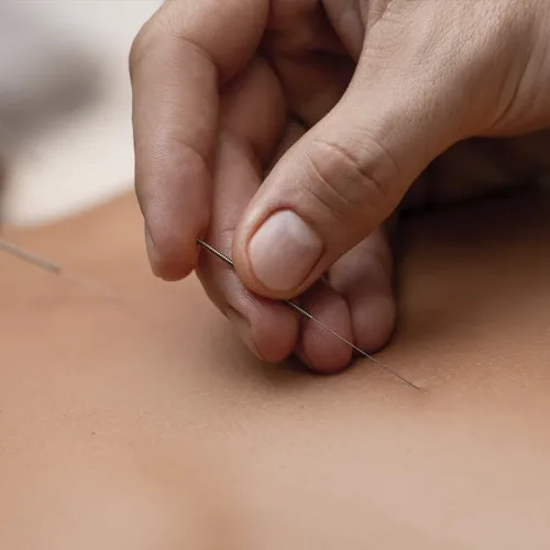 Acupuntura ayuda en la sanación de dolores